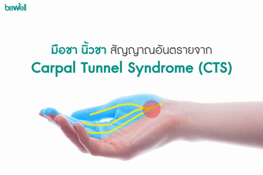 มือชา นิ้วชา สัญญาณอันตรายจาก  Carpal Tunnel Syndrome