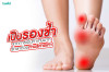 เป็นรองช้ำ จากการเดินทำงานมาก รักษาด้วยท่าบริหารเท้า